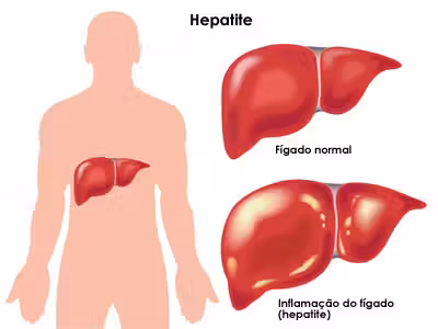 hepatite-resumo