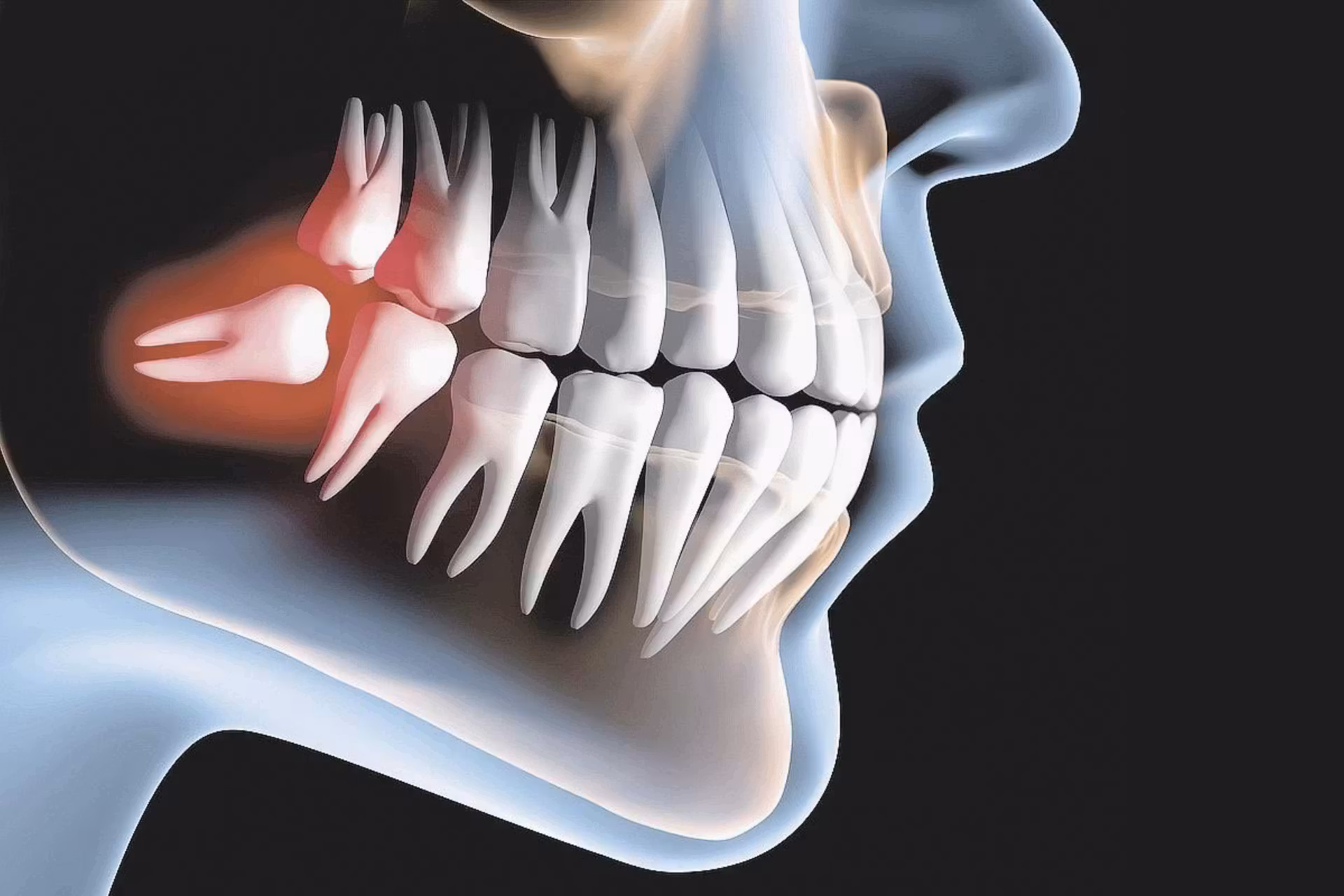 Os dentes do siso contém células-tronco capazes de formar ossos, tecido cardíaco e neurônios, descobriu pesquisa feita na Espana. - Foto: thiesenodontologia
