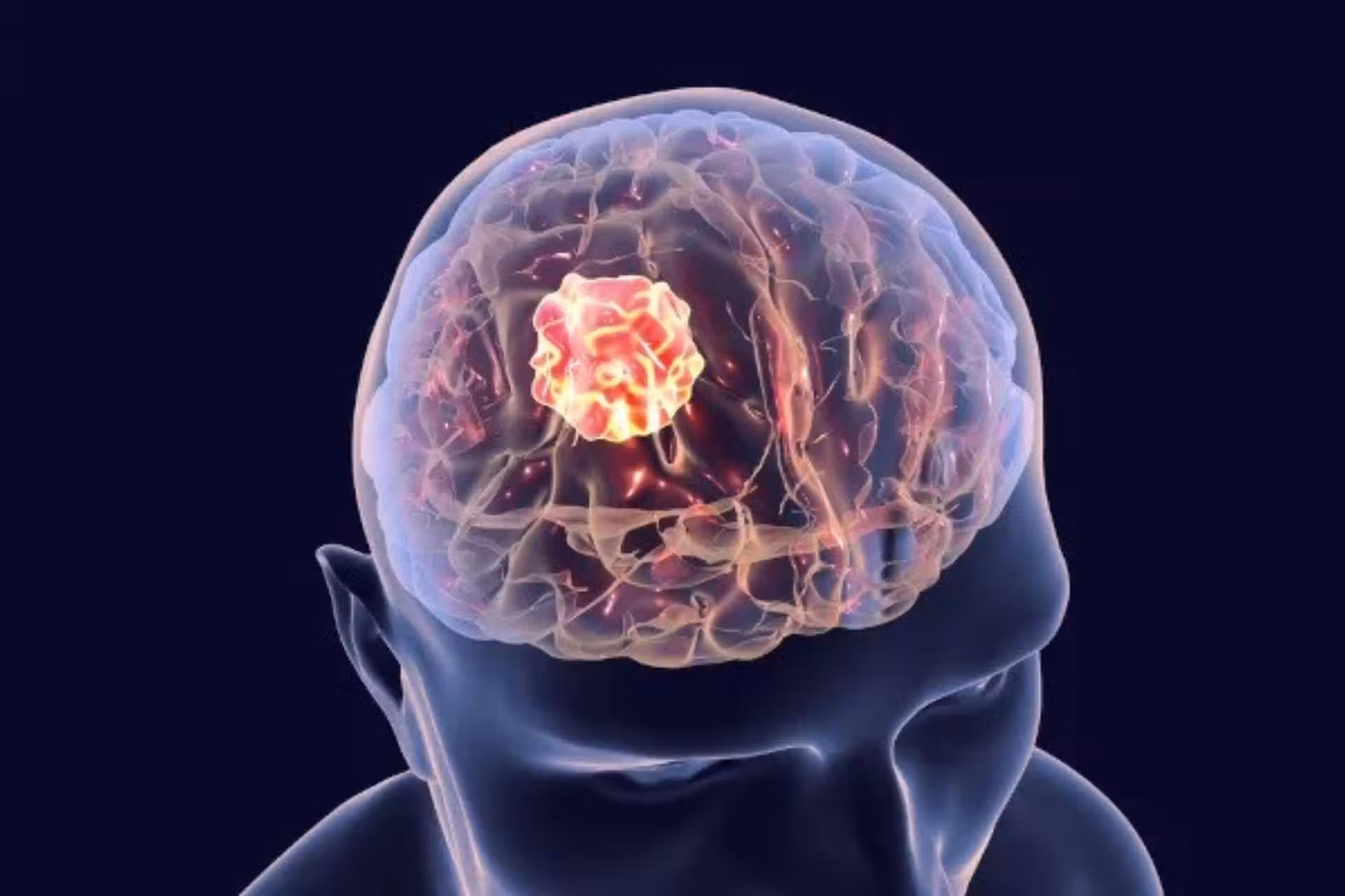 A Anvisa aprovou o registro do medicamento que impede o crescimento de tumor cerebral. - Foto: neuromadoacustico