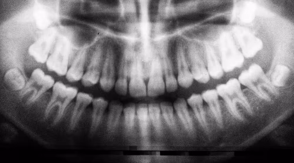 Os dentes do siso contém células-tronco capazes de formar ossos, tecido cardíaco e neurônios. - Foto: Umanoide/Unsplash