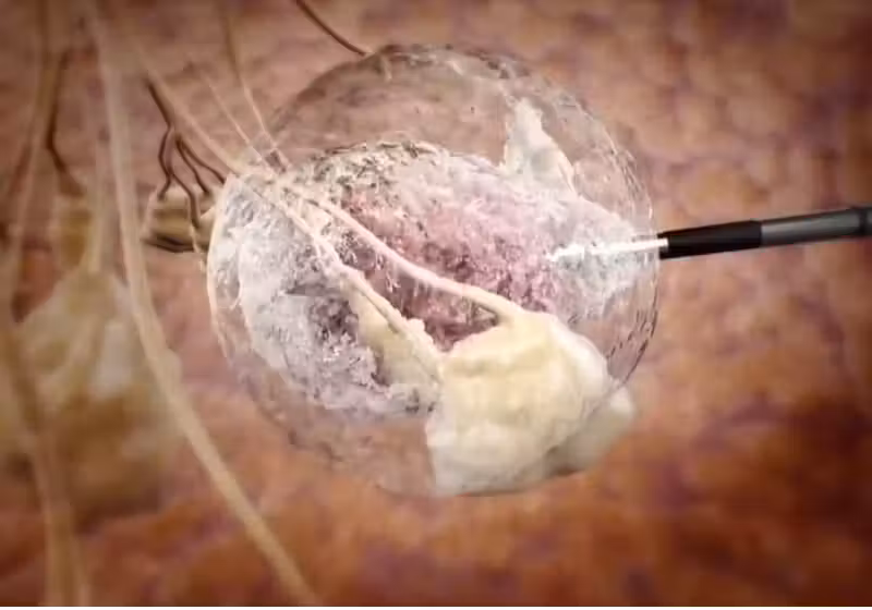A nova técnica utiliza crioablação para destruir tumores de câncer de mama de até 2 cm - Foto: Reprodução/EPTV