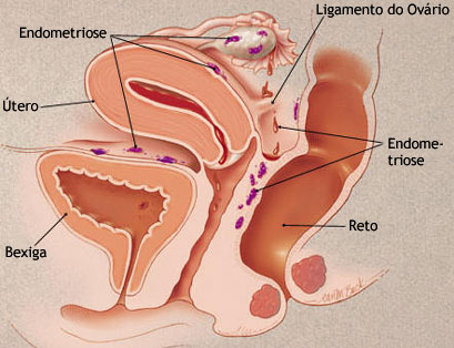 endometriose
