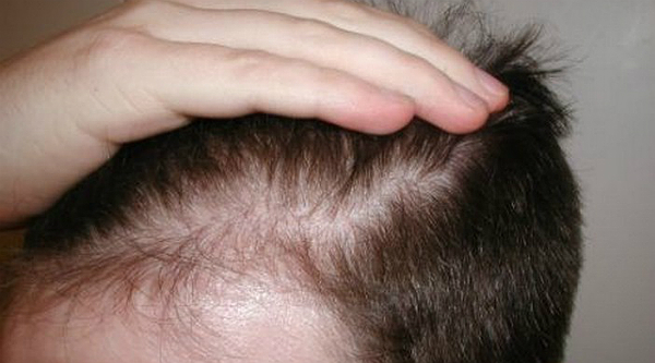 calvicie1