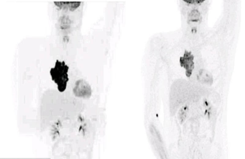 Foto: Da esquerda para a direita, primeira imagem mostra o tumor quando começou o tratamento. Imagem seguinte mostra o tumor em 21 de dezembro de 2015, pouco antes de ele deixar o Natal em casa 