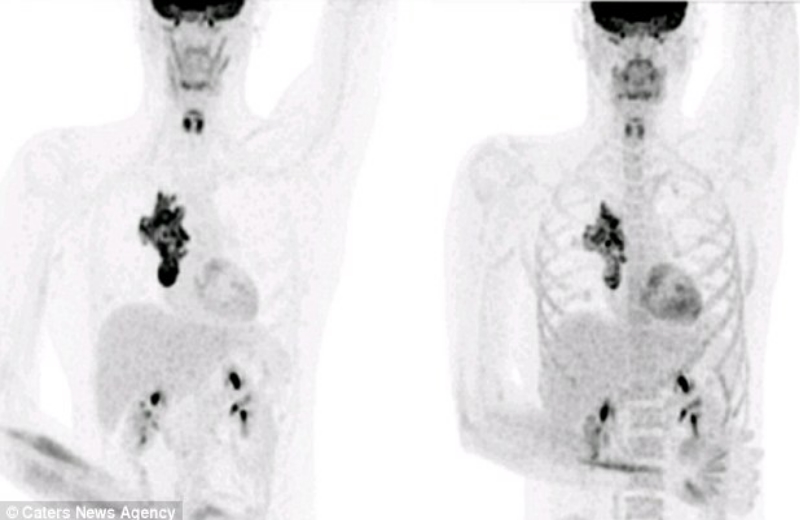 Á esquerda a radiografia de 21 de janeiro de 2015, quando Eastwood voltou dos EUA à Direita, em 11 de fevereiro de 2016 mostra o encolhimento do tumor sem uso de qualquer droga, comprovando a eficácia do transplante