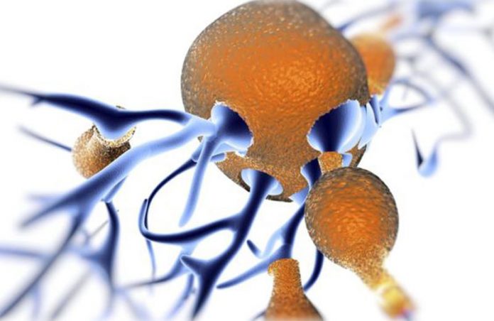 alzheimer-placas-close-1|Alzheimer-placas-close-2 |