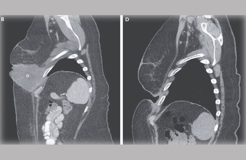 Foto: New England Journal of Medicine