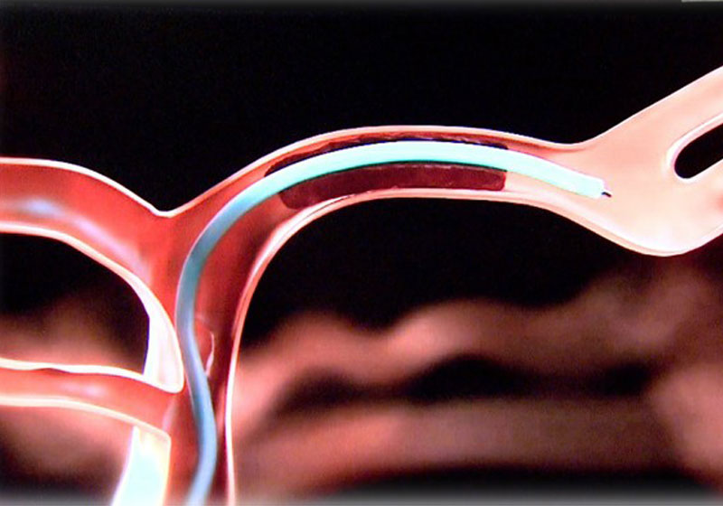 Microcateter introduzido na artéria cerebral - Foto: Reprodução