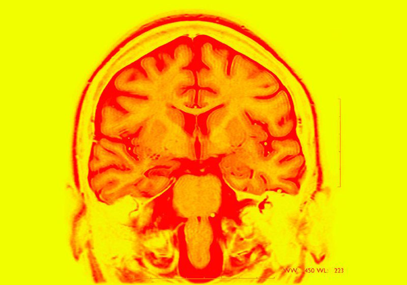 Ressonância magnética de cérebro epiléptico