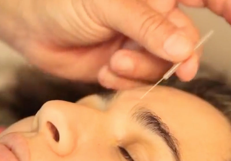 Acupuntura - Foto: reproduçãp / Youtube / Momento Ambiental