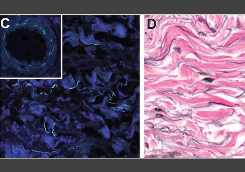 Feixes de colágeno fibrilar (azul esc.) e colágeno (rosa) - Fotos: JILL GREGORY / MOUNT SINAI HEALTH SYSTEM