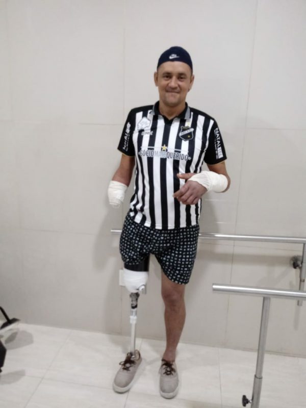 Pablo Diego com a prótese - Foto: arquivo pessoal / divulgação autorizada