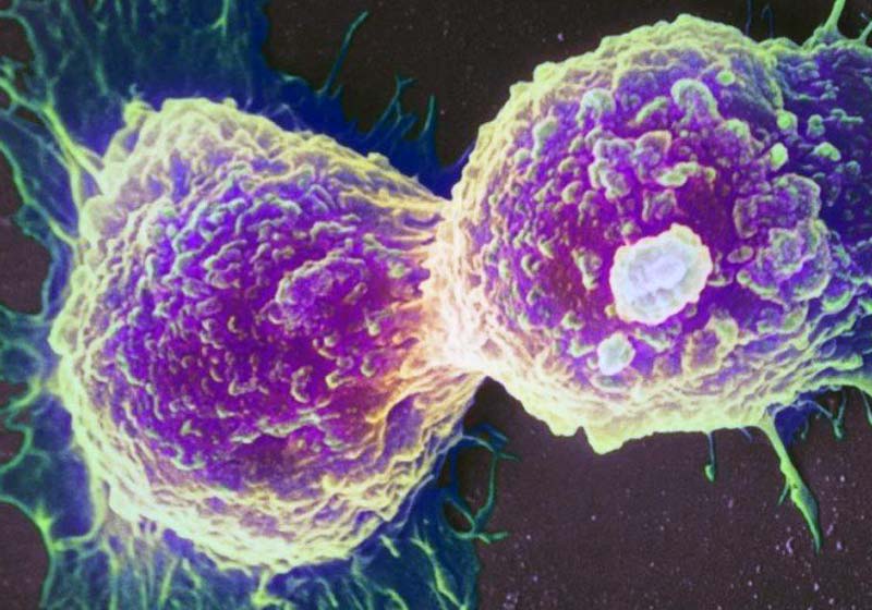 Células de câncer de mama - Foto: Science Photo Library/Latinstock|Judy Perkins - Foto: arquivo pessoal