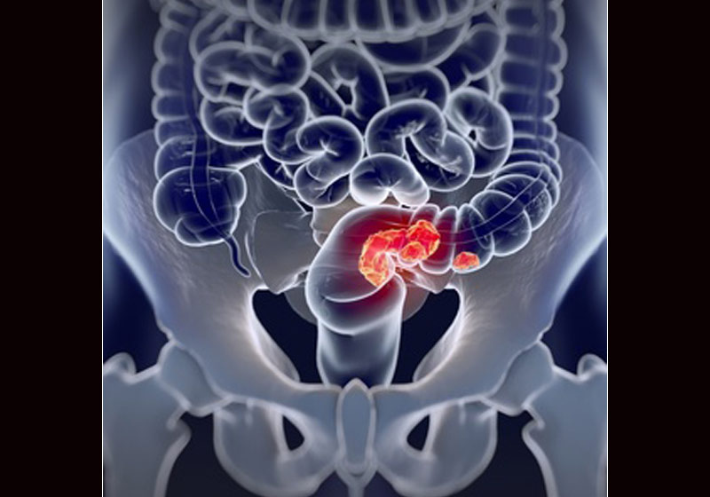 Câncer colorretal - Foto: iStock