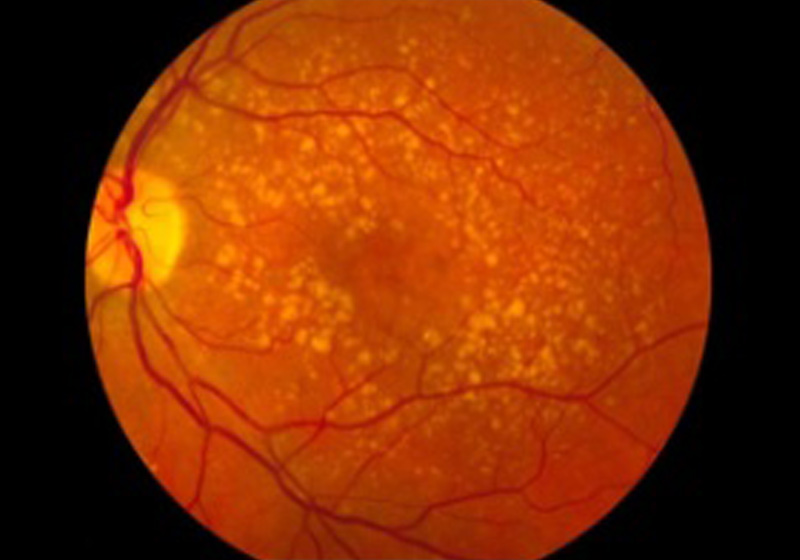 Fundo de olho com Degeneração macular - Foto: Wikimedia Commons||