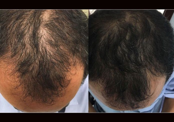 tonico-careca-close|tonico-calvicie-close Antes e depois de Marcelo Aparecido da Silva - Fotos: arquivo pessoal|Antes e depois de Marcelo Aparecido da Silva - Fotos: arquivo pessoal