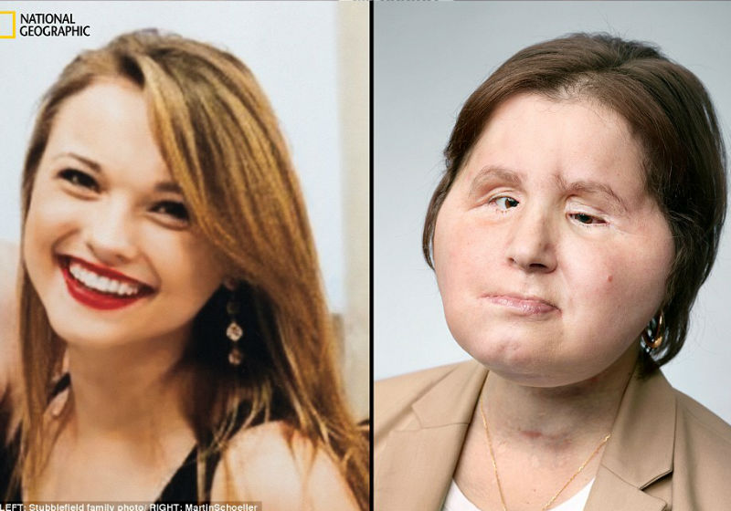 Katie Stubblefield - antes e depois - Foto:National Geographic|Os pais de Katie