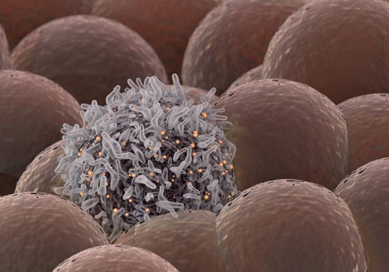 Células de câncer - Foto: iStock/Thinkstock