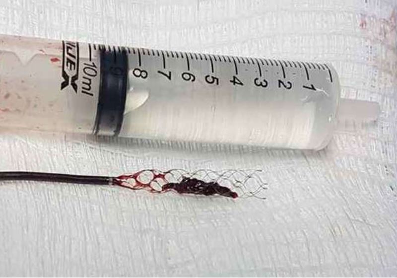 Catéter para retirar coágulo - Foto: reprodução|Catéter para retirar coágulo - Foto: reprodução|