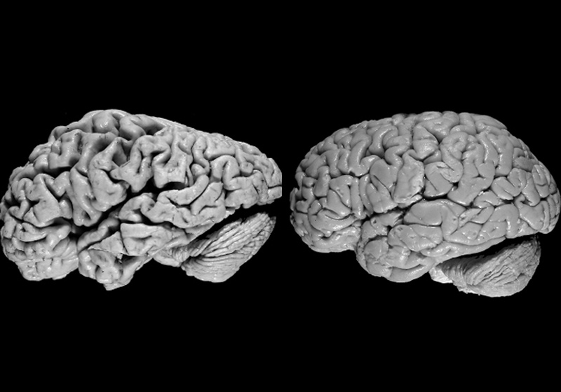 Cérebro com (esq) e sem Alzheimer - Foto: Universidade da Califórnia