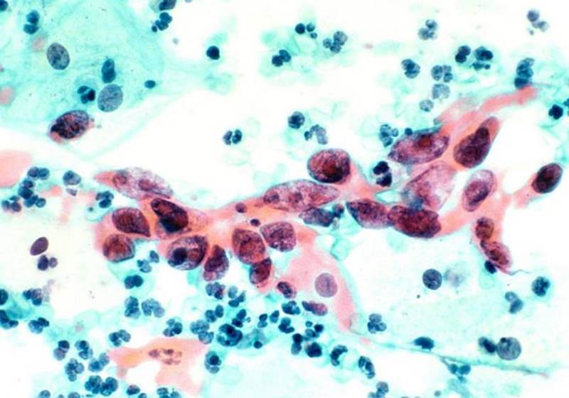 Espécime citológico mostrando câncer cervical. Fonte: Instituto Nacional do Câncer / Wikimedia Commons