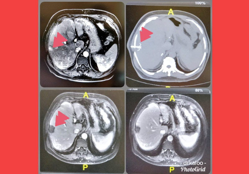 Técnica para destruir tumor - Foto: reprodução/drkaloo/Twiiter