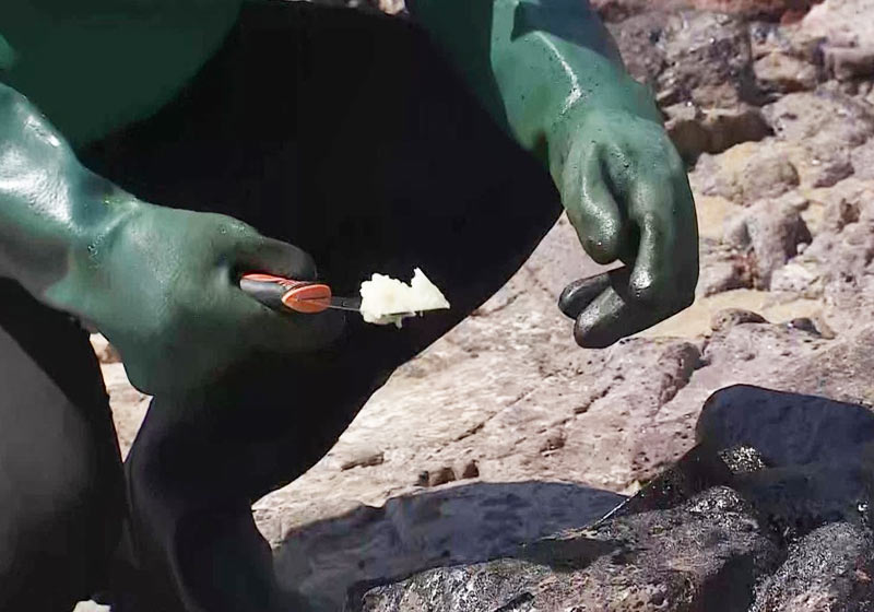 Biogel sendo aplicado em PE - Foto: Reprodução/TV Globo|