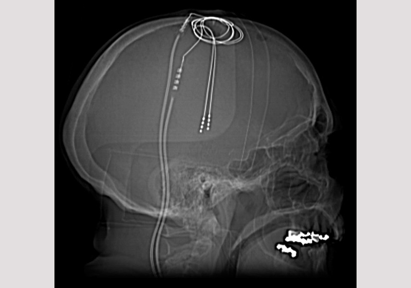 Estimulação cerebral / Parkinson- Foto: Dr. Craig Hacking