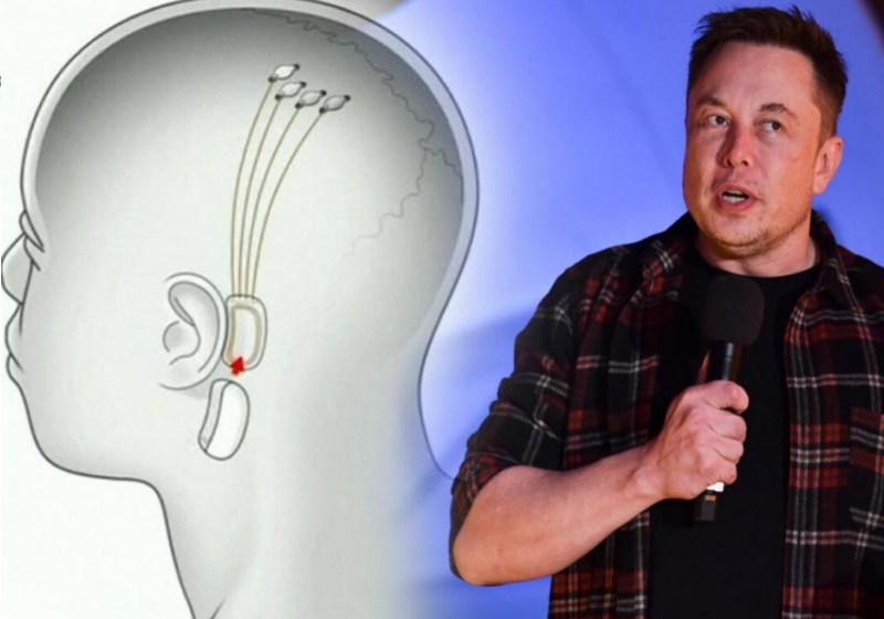 Elon Musk Lan A Chip Pra Combater Esquizofrenia E Autismo S Not Cia Boa