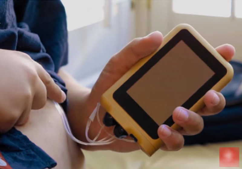 Pâncreas biônico - Foto: reprodução / Freethink