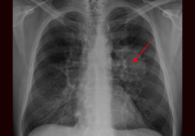 Câncer de pulmão - Foto: James Heilman