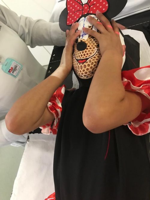 Máscara usada por Paloma - Foto: Hospital Baleia /divulgação