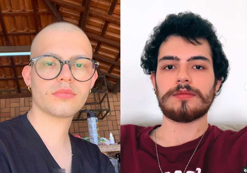 Artur Pacheco no tratamento e agora - Fotos: reprodução / Instagram