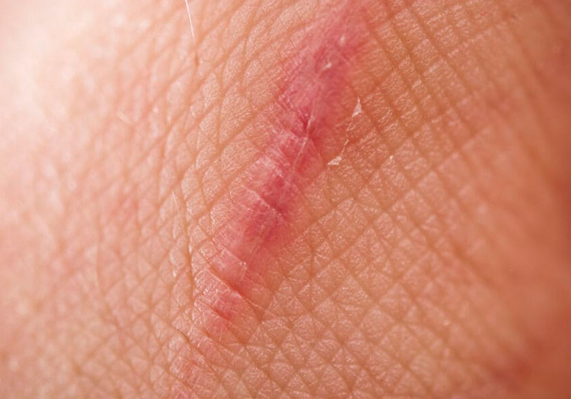 Ilustração de pele humana com cicatriz - Foto: Bastun/istock