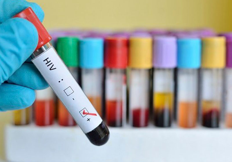 Teste de HIV - Foto: iStock