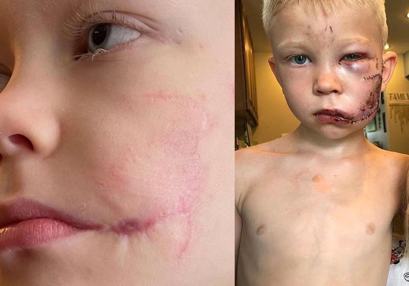 Bridger agora e após ser mordido pelo cão - Fotos: RobertWalker e arquivo