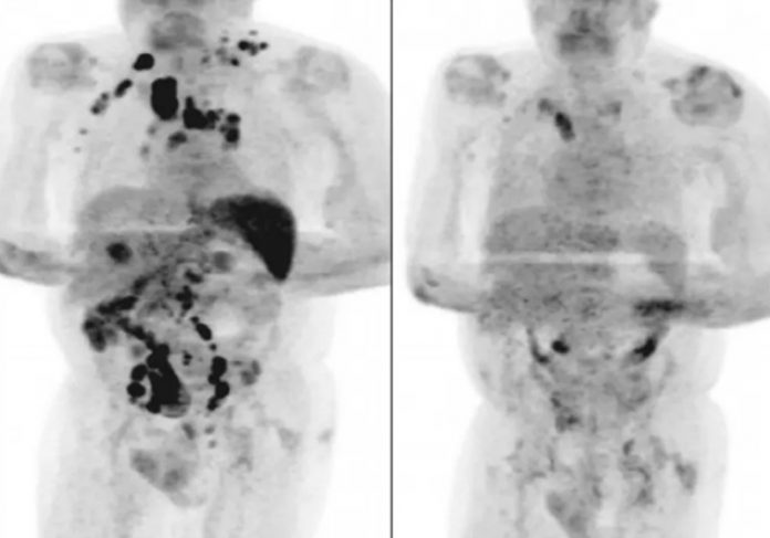 Tomografias mostram a remissão do câncer do paciente após Covid - Fotos: reprodução
