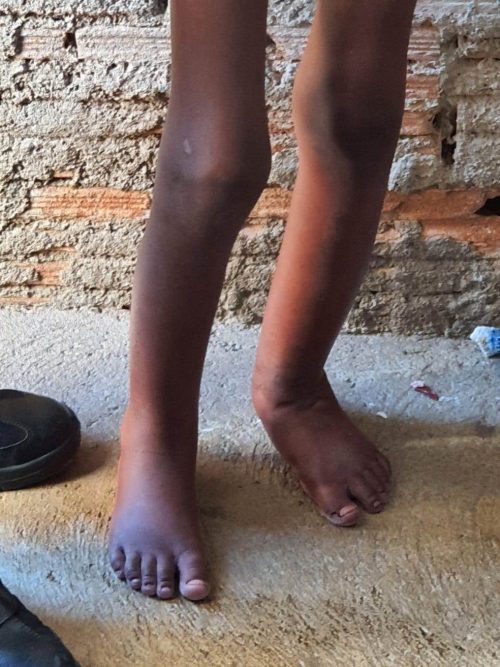 Pernas do menino acorrentado - Foto: Polícia Militar