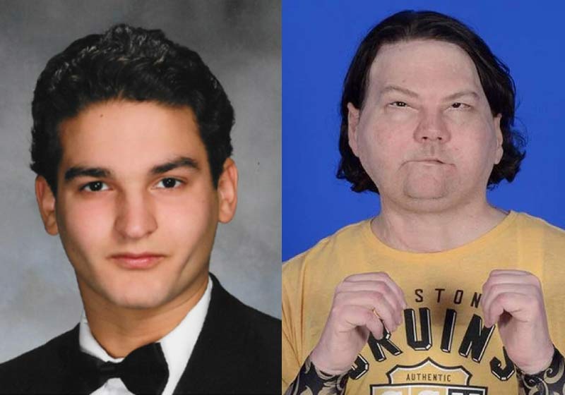 Joe DiMeo antes do acidente e agora - Foto: Reprodução/ NYU Langone Health