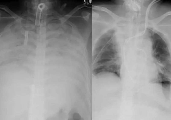 Exames de raio-x realizados antes e depois do 1º transplante de pulmão de doador vivo : as partes escuras na fotografia da direita representam as áreas transplantadas. - Foto: Cortesia do Hospital da Universidade de Kyoto