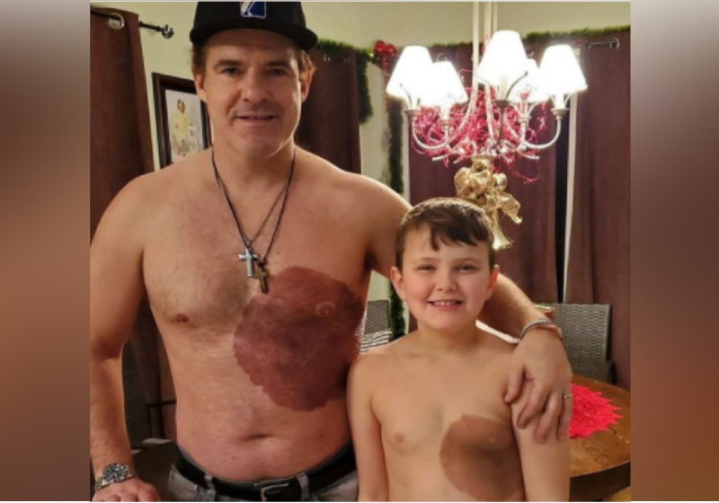 Derek tatuou a mesma marca de nascença do filho para incentivá-lo a gostar do corpo - Foto: reprodução CBS