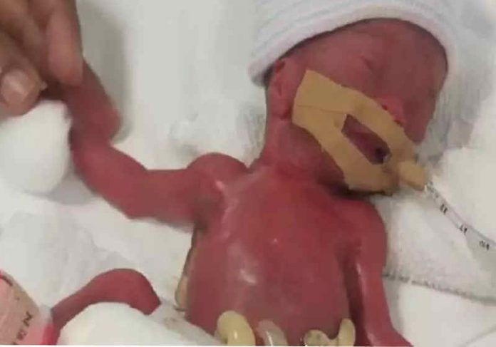 Bebê nasceu com 212 gramas – Foto: arquivo pessoal