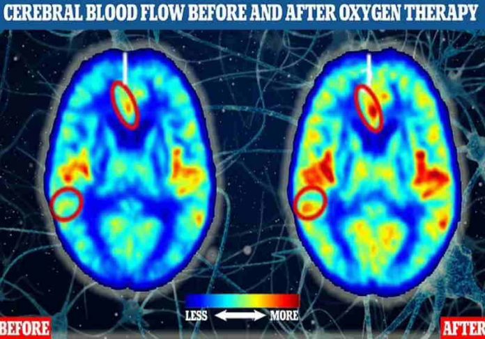 Os dois exames de ressonância magnética do cérebro de participantes humanos indicam o fluxo sanguíneo antes (à esquerda) e depois (à direita) de um dos participantes do estudo fazer a oxigenoterapia. Foto: Divulgação