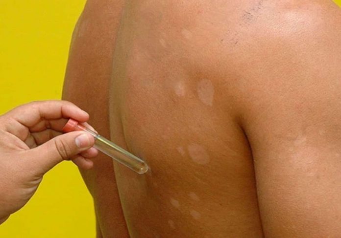 kit_hanseniase_capa O teste molecular para hanseníase é o primeiro do tipo, lançado no Brasil - Foto: reprodução