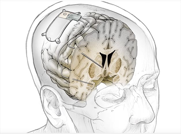 O dispositivo se localiza em cavidade no crânio, e se conecta à região doente do cérebro. Foto: Nature