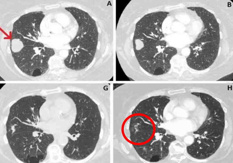 Canabidiol reduz 76% praticamente desaparecendo o tumor no pulmão Foto: Divulgação