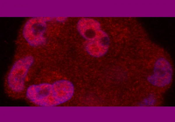 Na foto, o receptor de andrógeno do câncer de próstata é mostrado em vermelho escuro - Foto: Escola de Medicina da Universidade de St Louis