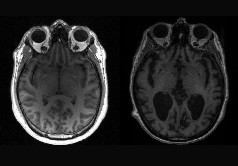 Os cientistas descobriram as causas do avanços do Alzheimer no cérebro humano - Foto: University of Cambridge/AFP