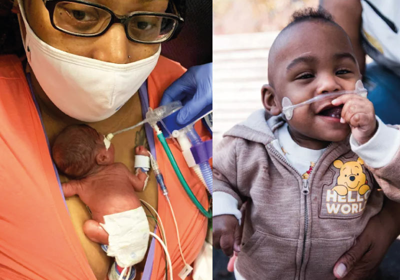 Curti, o bebê com 420 gramas, agora tem 1 ano e é considerado o mais prematuro do mundo a sobreviver - Foto: arquivo pessoal