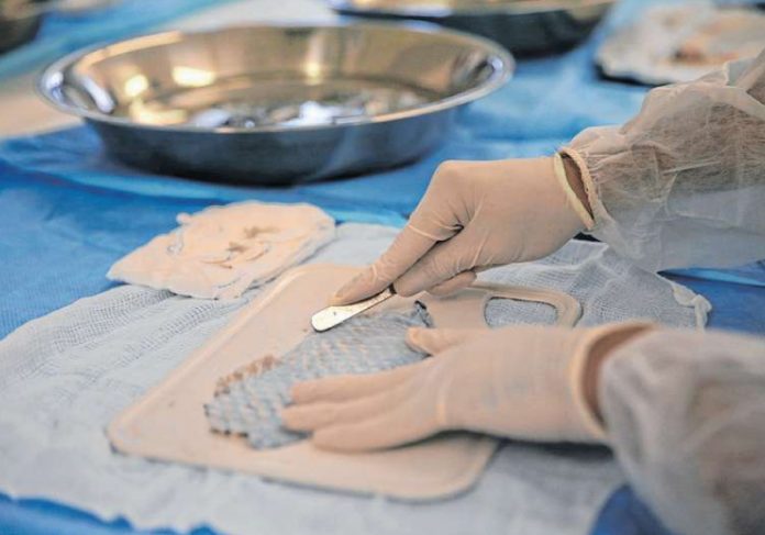 A pele de tilápia foi utilizada pela primeira vez na reconstrução vaginal de mulheres com doença rara - Foto: reprodução UFC